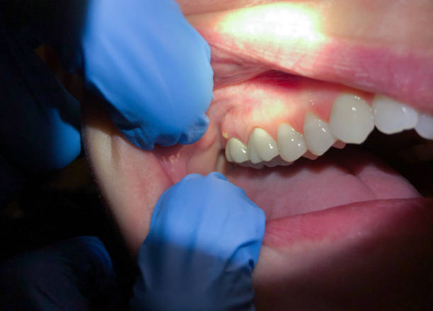 Best Knocked-Out Tooth (Avulsed Tooth) Treatment in Mikes, TX